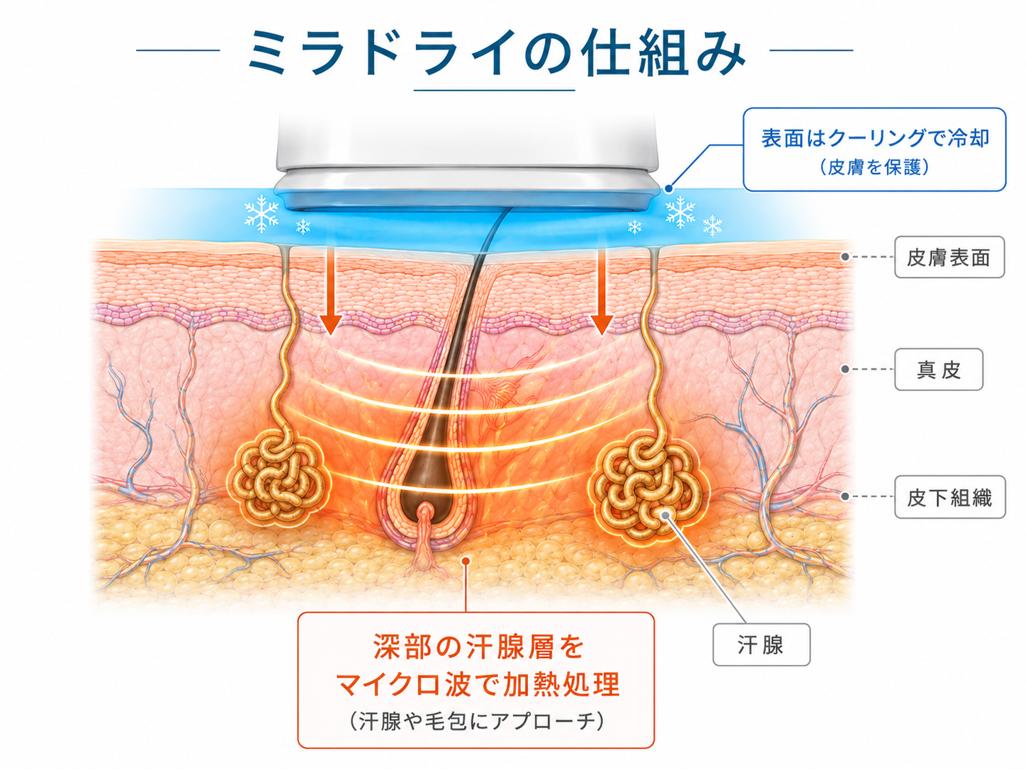 ミラドライの仕組みを示した皮膚の断面図。表面はクーリングで冷却して皮膚を保護し、深部の汗腺層をマイクロ波で加熱処理することを示している