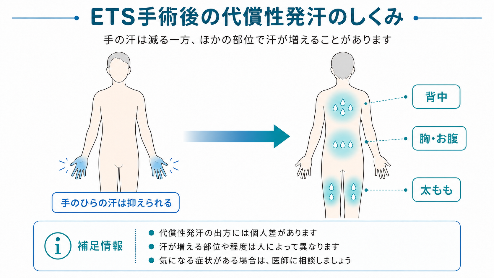 ETS手術後の代償性発汗のしくみ：手の汗が減る一方、背中・胸・お腹・太ももなど別の部位で汗が増えるイメージ図
